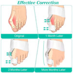 Bunion Splint and Big Toe Straightener – Orthopedic Hallux Valgus Corrector for Foot Pain Relief & Pedicure Care - Image 5